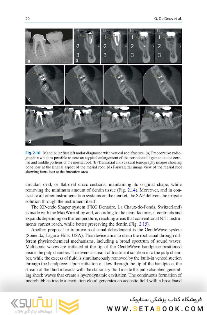 Shaping for Cleaning the Root Canals : A Clinical-Based Strategy 2022