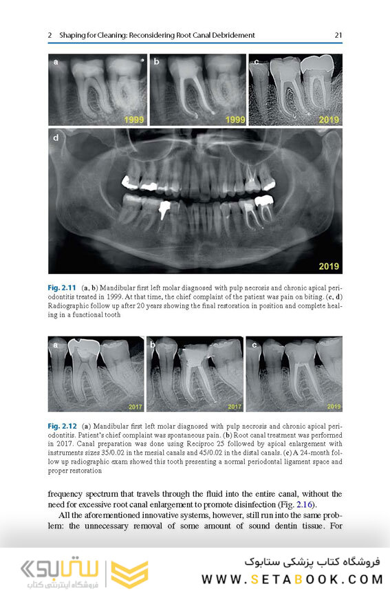 Shaping for Cleaning the Root Canals : A Clinical-Based Strategy 2022