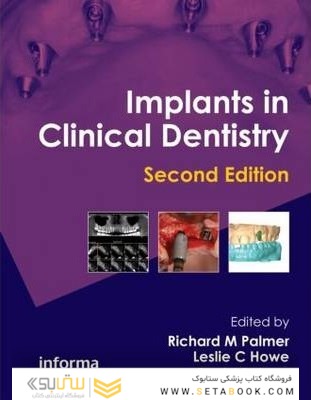 Implants in Clinical Dentistry 2nd Edición