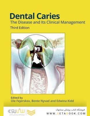 Dental Caries: The Disease and its Clinical Management 3rd Edición