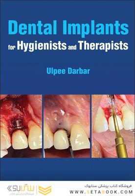 Dental Implants for Hygienists and Therapists 1st Edición