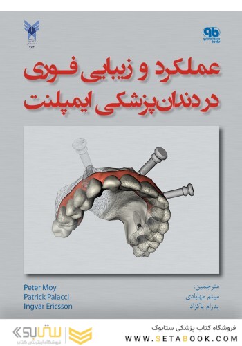 عملکرد و زیبایی فوری در دندانپزشکی ایمپلنت