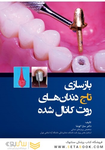 بازسازی تاج دندان های روت کانال شده