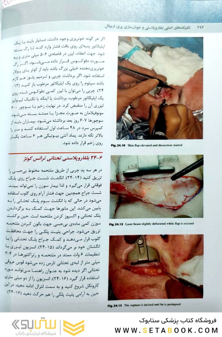 تکنیک های اصلی بلفاروپلاستی و جوان سازی پری اربیتال