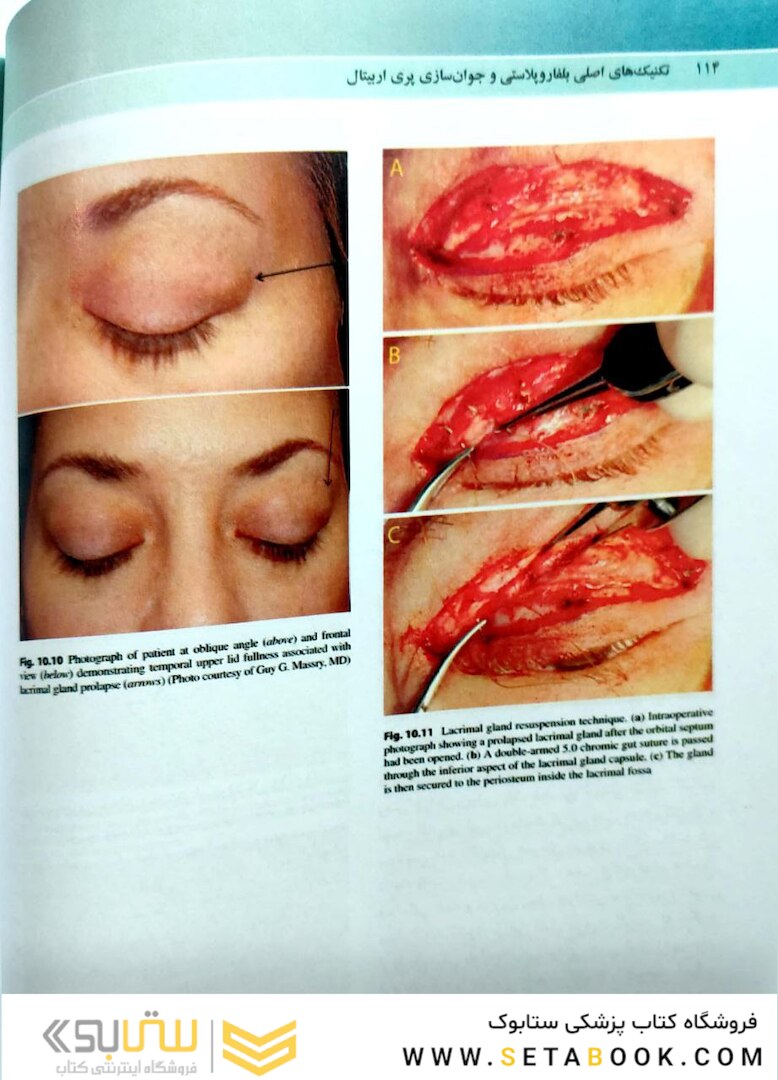 تکنیک های اصلی بلفاروپلاستی و جوان سازی پری اربیتال