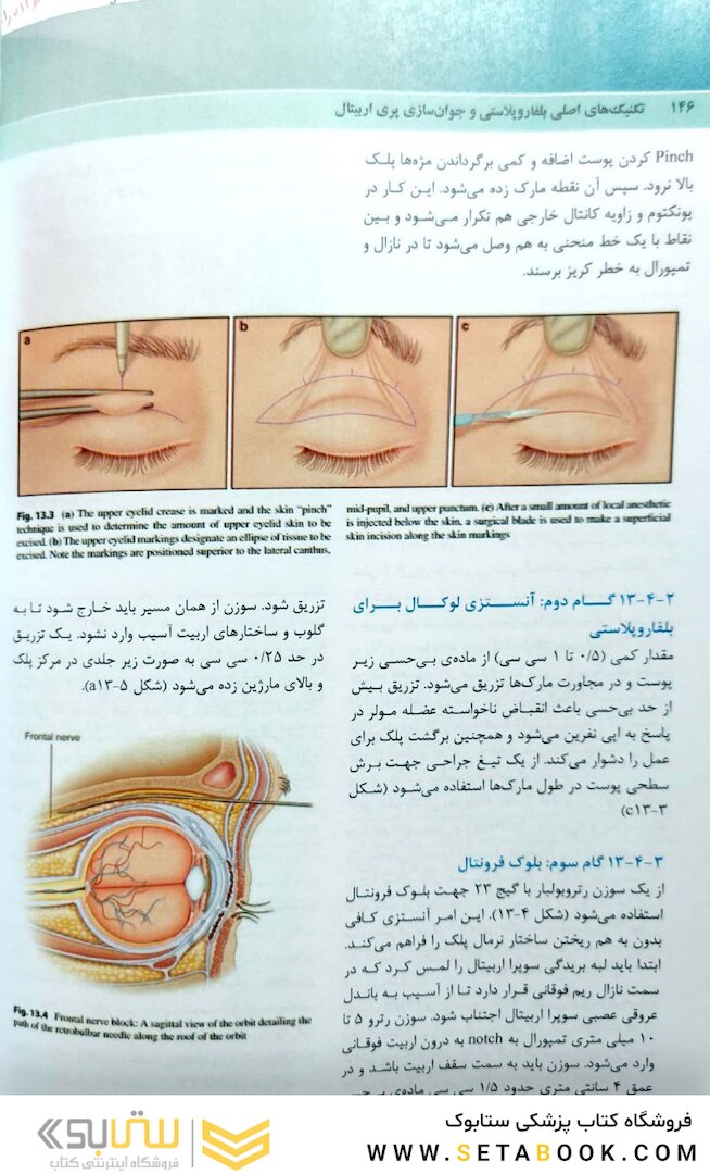 تکنیک های اصلی بلفاروپلاستی و جوان سازی پری اربیتال