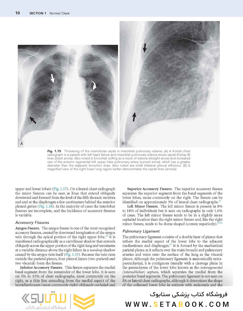 Muller’s Imaging of the Chest, 2nd Edition2018