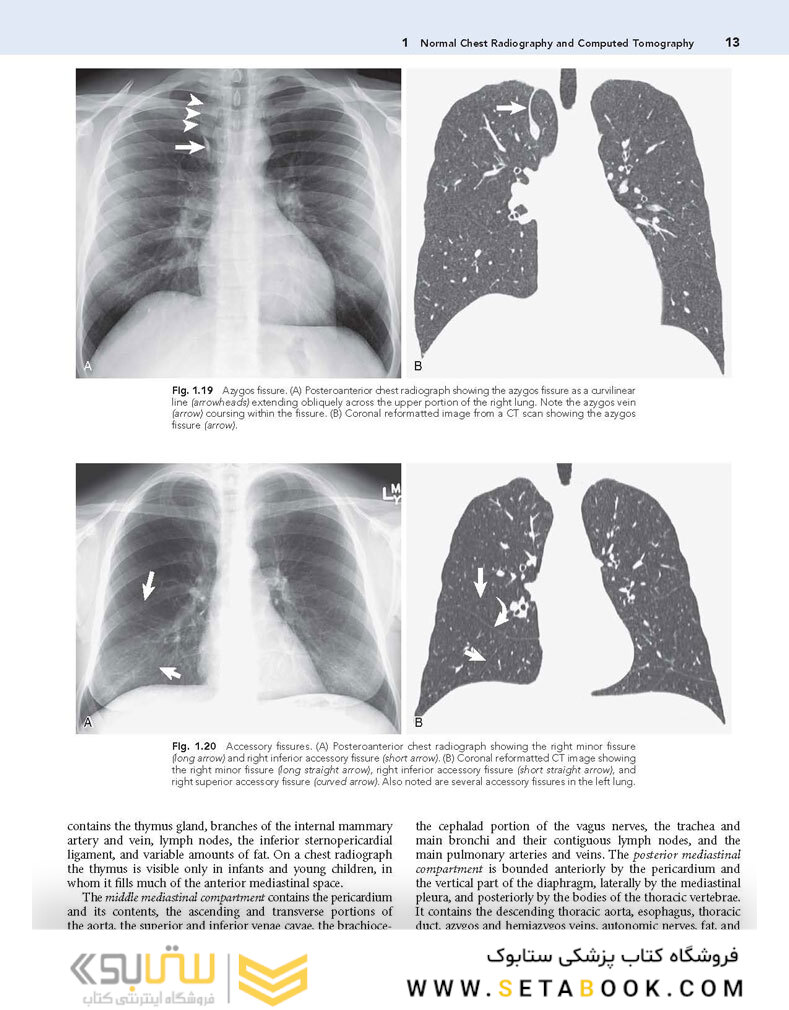 Muller’s Imaging of the Chest, 2nd Edition2018