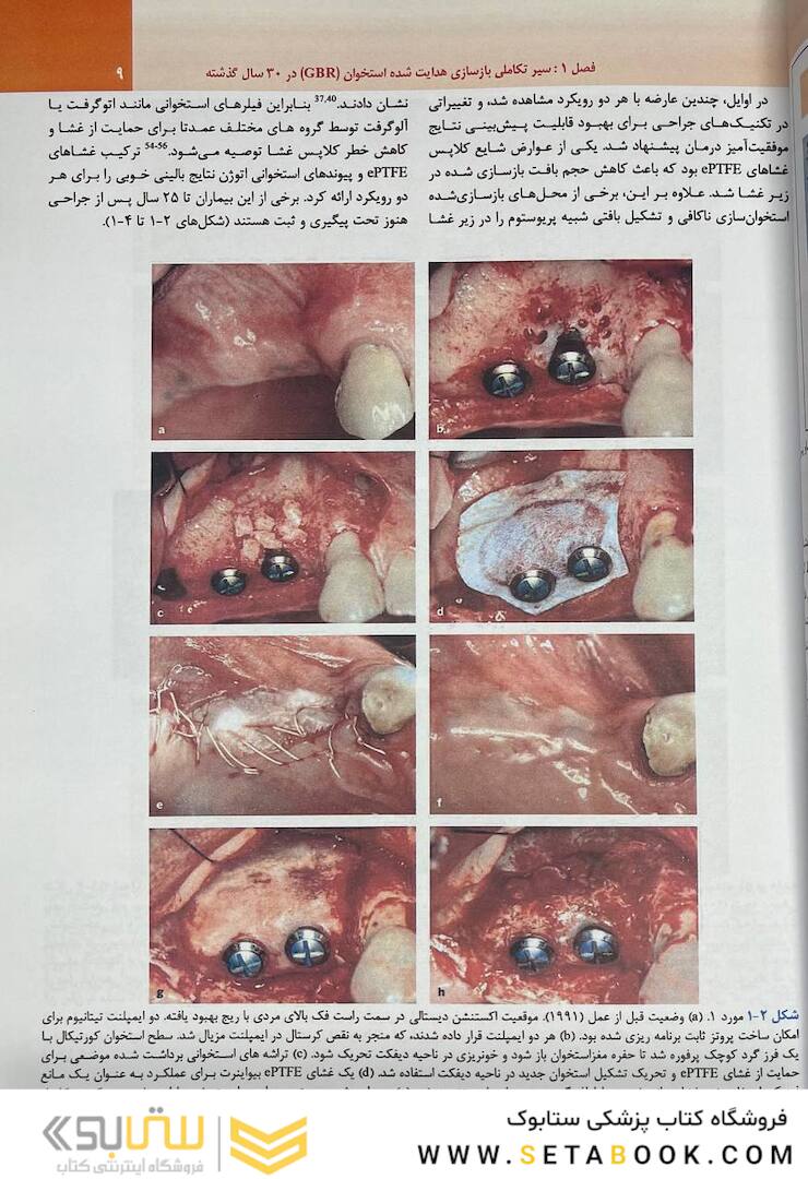 بازسازی استخوان هدایت شده در طی 30 سال