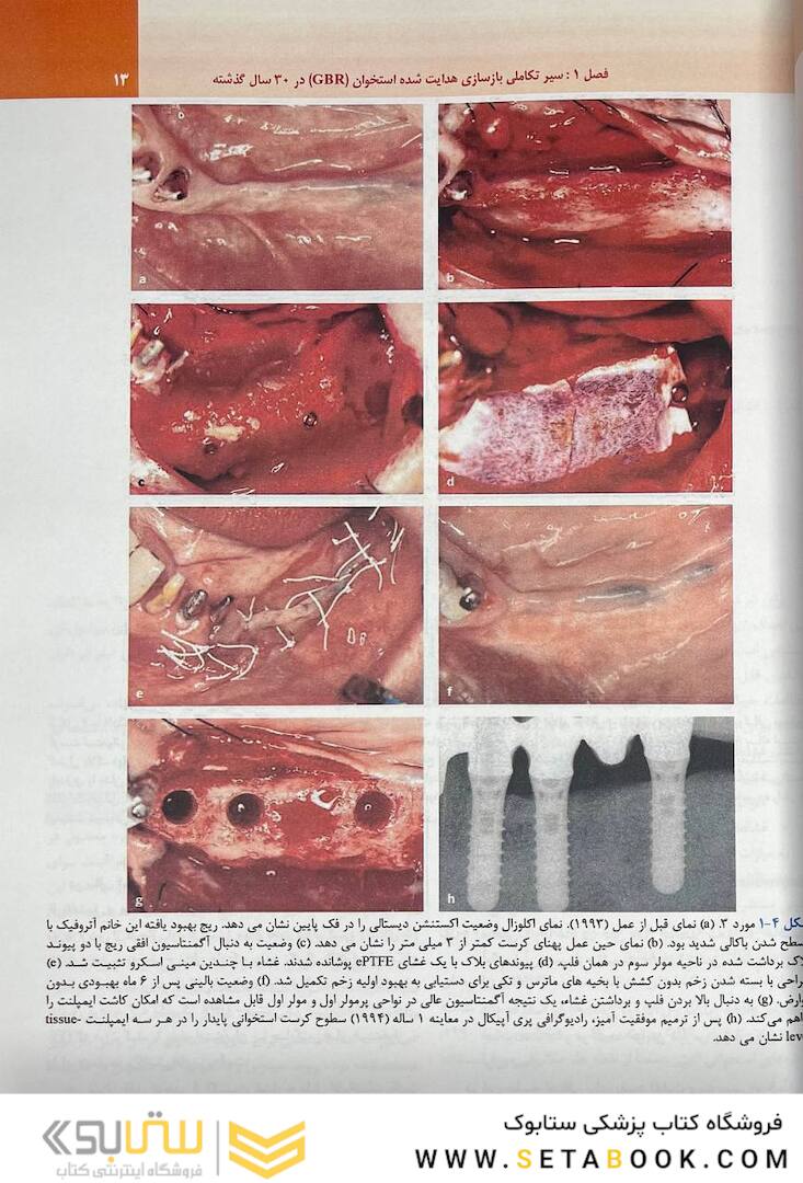 بازسازی استخوان هدایت شده در طی 30 سال