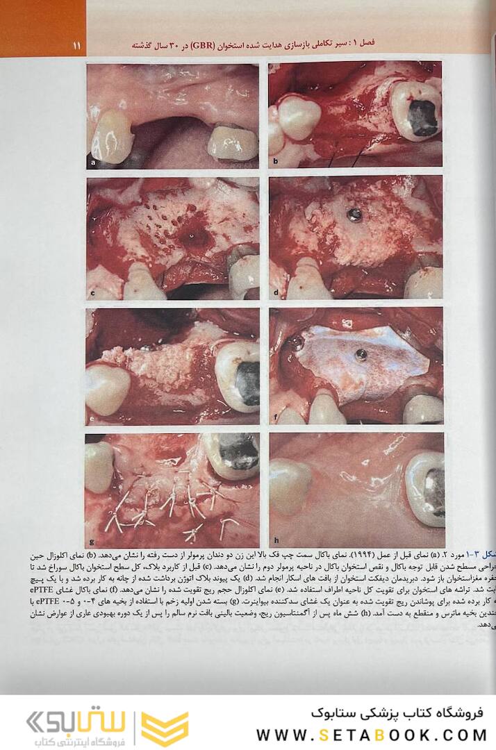 بازسازی استخوان هدایت شده در طی 30 سال