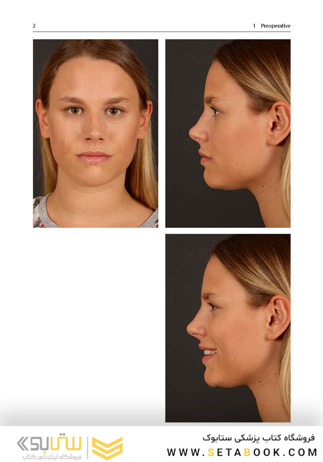 Aesthetic Septorhinoplasty2016سپتورینوپلاستی زیبایی