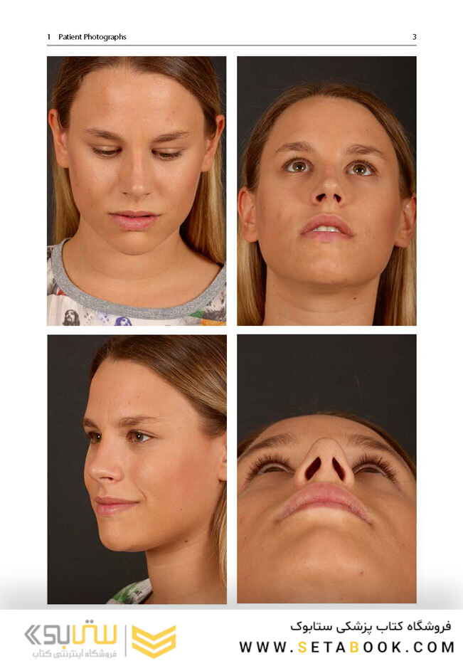 Aesthetic Septorhinoplasty2016سپتورینوپلاستی زیبایی