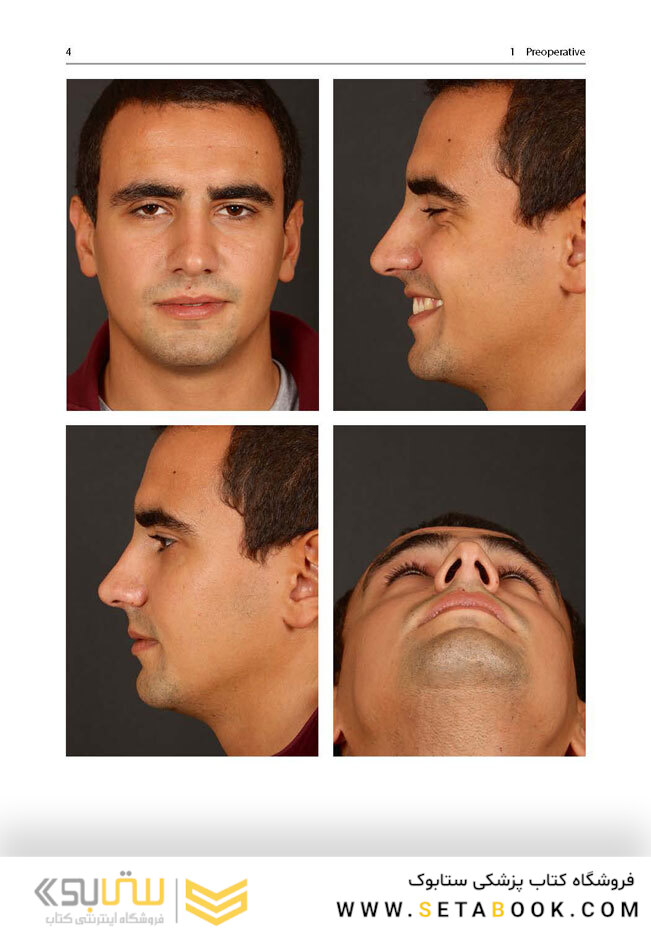 Aesthetic Septorhinoplasty2016سپتورینوپلاستی زیبایی