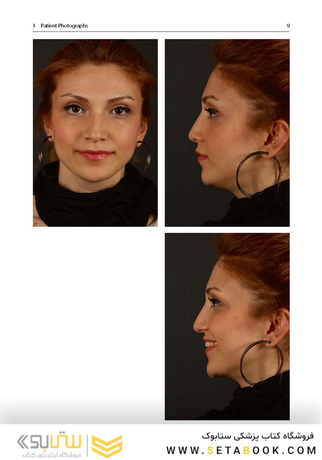 Aesthetic Septorhinoplasty2016سپتورینوپلاستی زیبایی