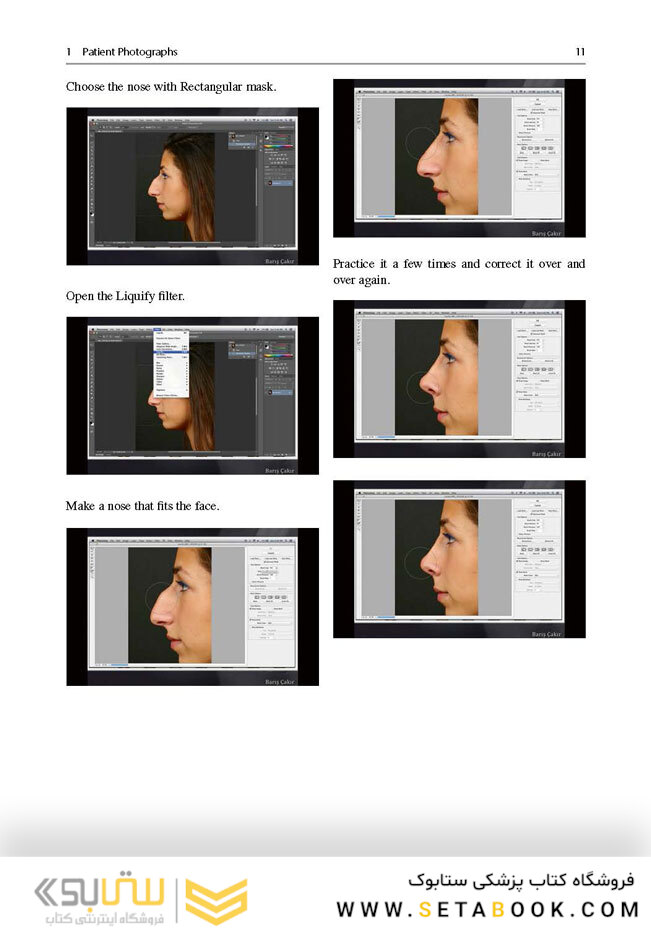 Aesthetic Septorhinoplasty2016سپتورینوپلاستی زیبایی