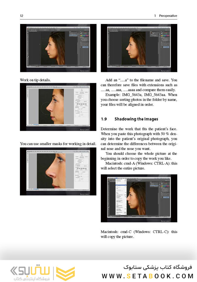 Aesthetic Septorhinoplasty2016سپتورینوپلاستی زیبایی