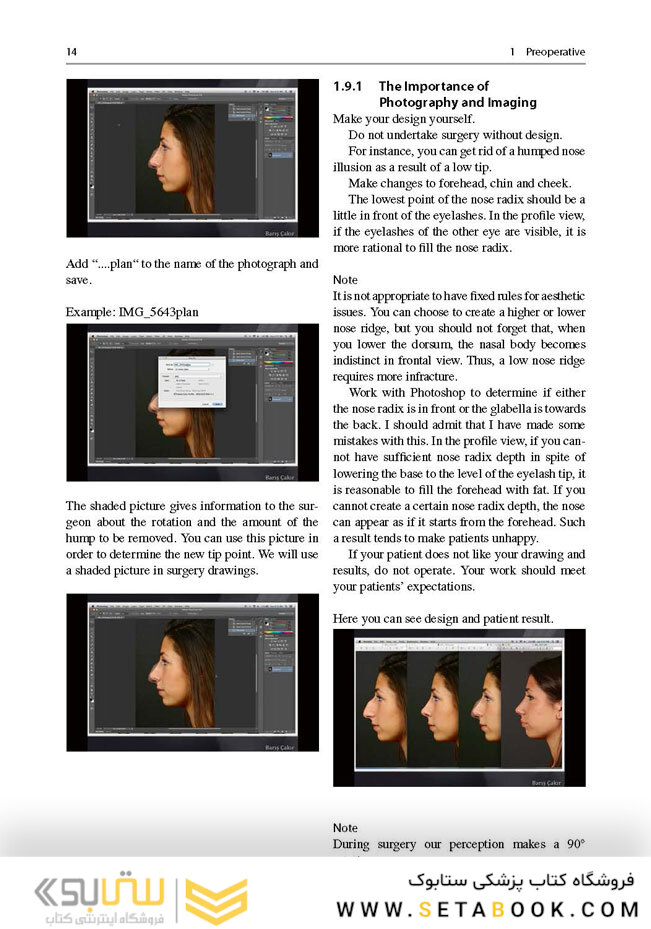 Aesthetic Septorhinoplasty2016سپتورینوپلاستی زیبایی