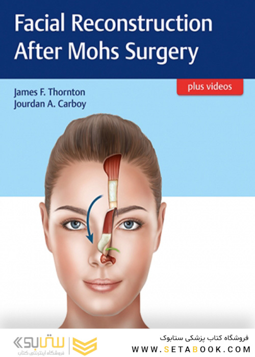 Facial Reconstruction After Mohs Surgery