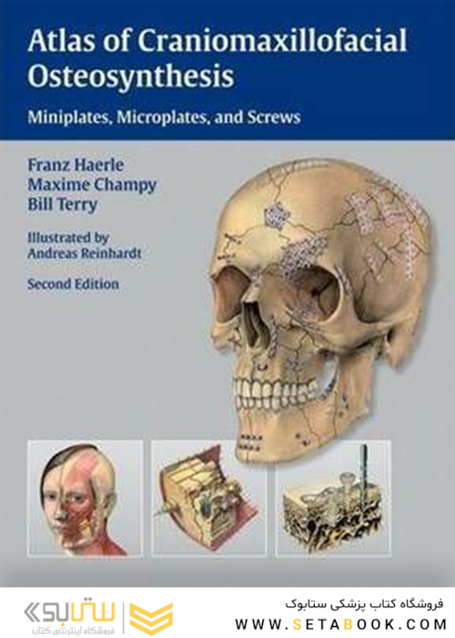 Atlas of Craniomaxillofacial Osteosynthesis : Microplates, Miniplates,and Screws
