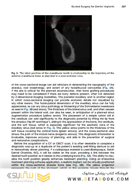 Implant Procedures for the General Dentist, An Issue of Dental Clinics of North America