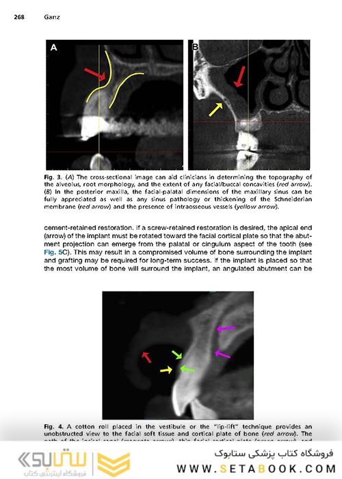 Implant Procedures for the General Dentist, An Issue of Dental Clinics of North America