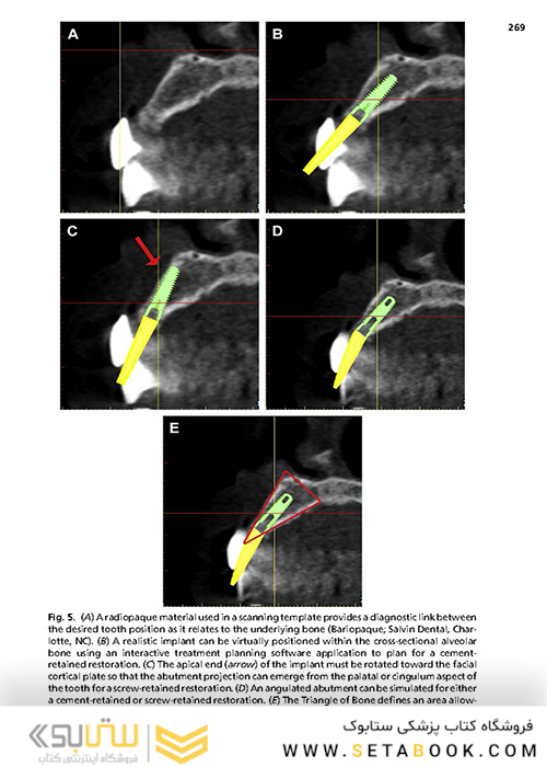 Implant Procedures for the General Dentist, An Issue of Dental Clinics of North America