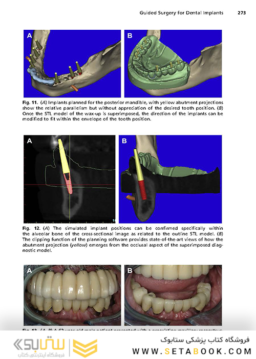 Implant Procedures for the General Dentist, An Issue of Dental Clinics of North America