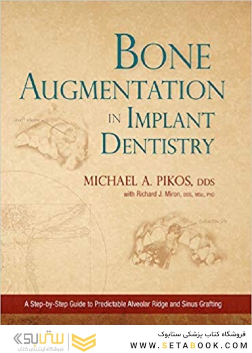 Bone Augmentation in Implant Dentistry: A Step-by-Step Guide to Predictable Alveolar Ridge and Sinus Grafting 1st Edition 2019