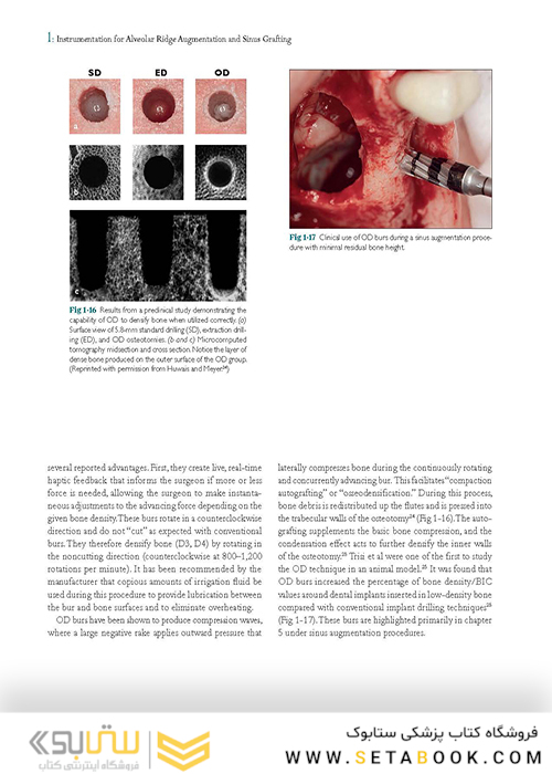 Bone Augmentation in Implant Dentistry: A Step-by-Step Guide to Predictable Alveolar Ridge and Sinus Grafting 1st Edition 2019