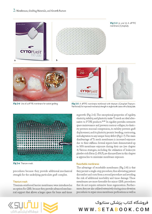 Bone Augmentation in Implant Dentistry: A Step-by-Step Guide to Predictable Alveolar Ridge and Sinus Grafting 1st Edition 2019