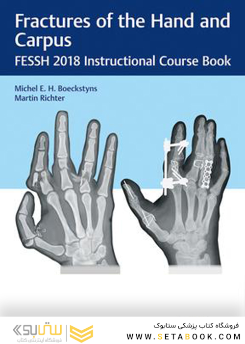 Fractures of the Hand and Carpus: FESSH 2018 Instructional Course Book 1st Edition
