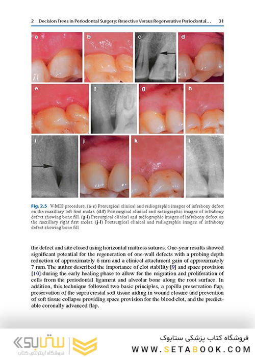  Advances in Periodontal Surgery: A Clinical Guide to Techniques and Interdisciplinary Approaches 1st ed. 2020 Edition پیشرفت در جراحی پریودنتال: راهنمای بالینی تکنیک ها و رویکردهای بین رشته ای
