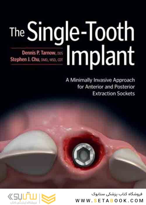 The Single-Tooth Implant: A Minimally Invasive Approach for Anterior and Posterior Extraction Sockets 1st Edition 2020