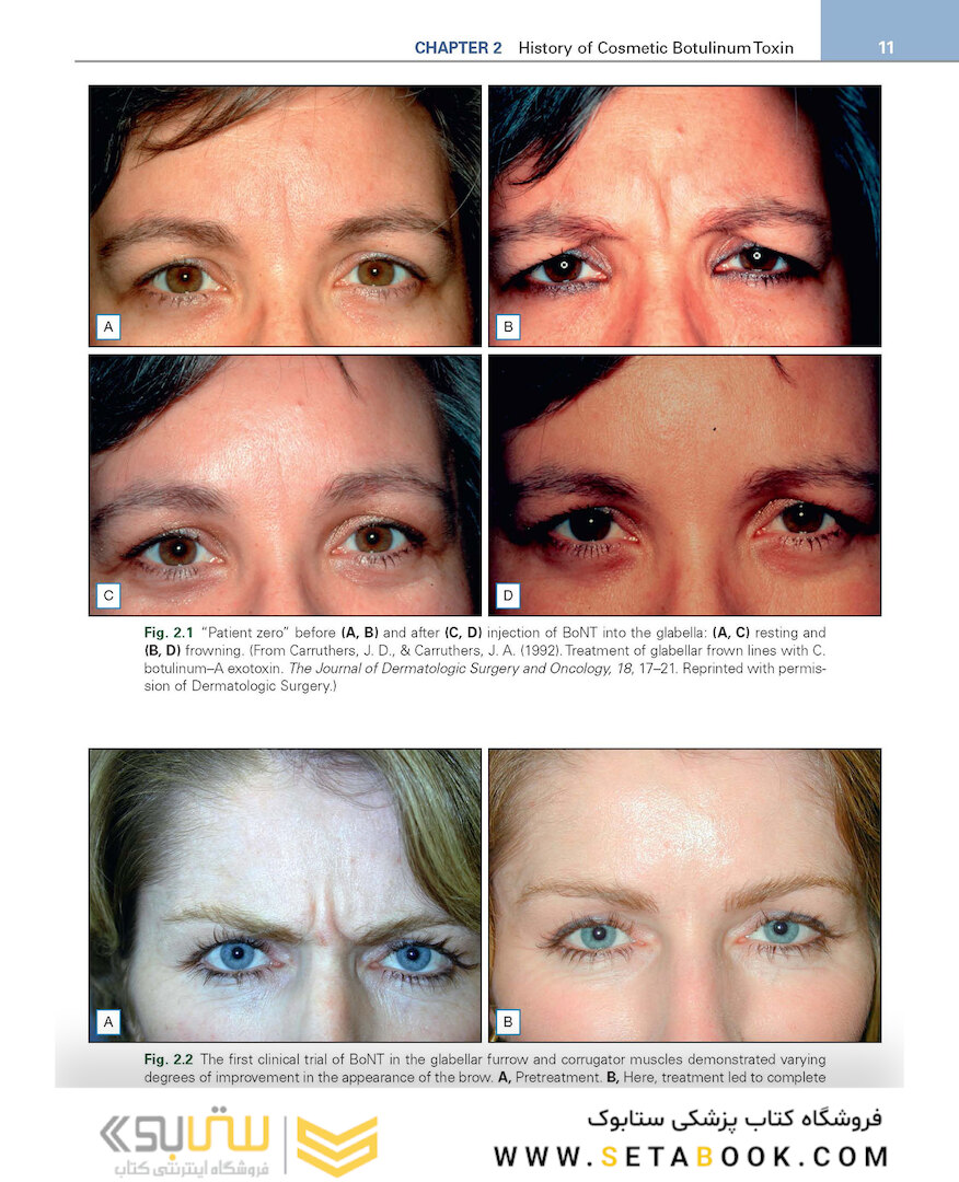 Procedures in Cosmetic Dermatology: Botulinum Toxin 5thEdition