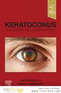 Keratoconus,E-Book: Diagnosis and Management
