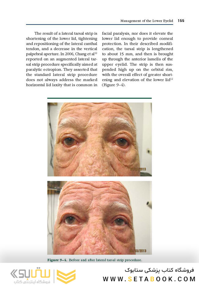 Facial Paralysis A Comprehensive Rehabilitative Approach