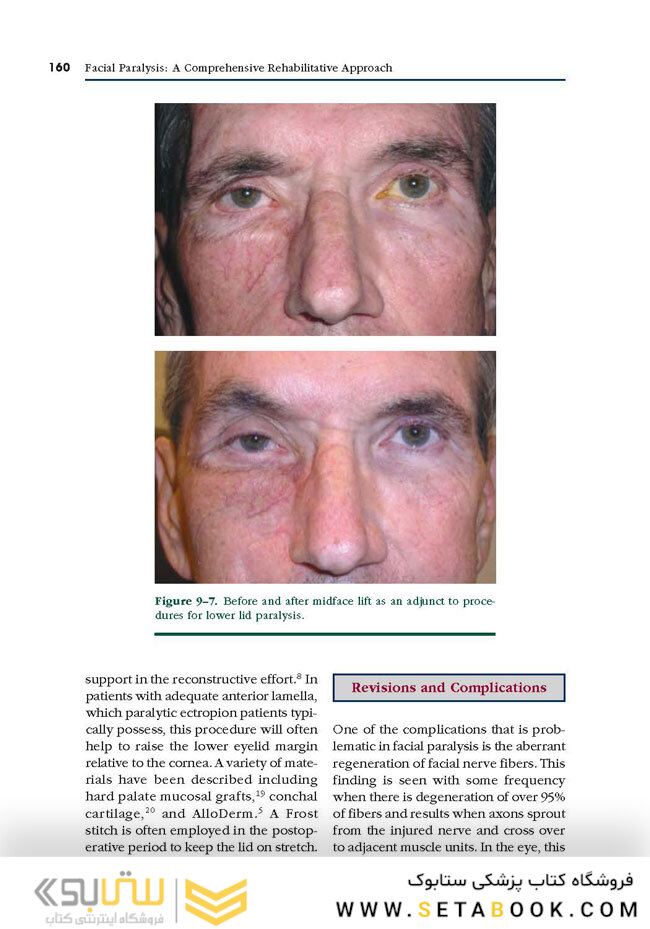 Facial Paralysis A Comprehensive Rehabilitative Approach
