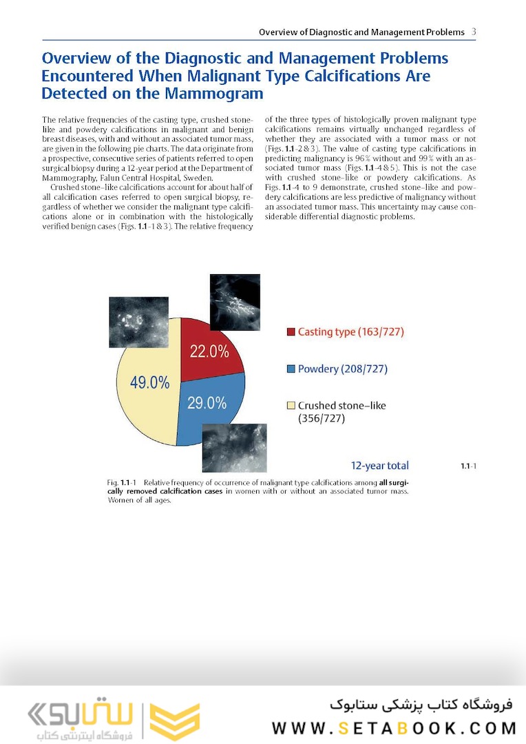 Breast Cancer: Early Detection with Mammography: Crushed Stone-like Calcifications: The Most Frequent Malignant Type 1st Edicion 2008