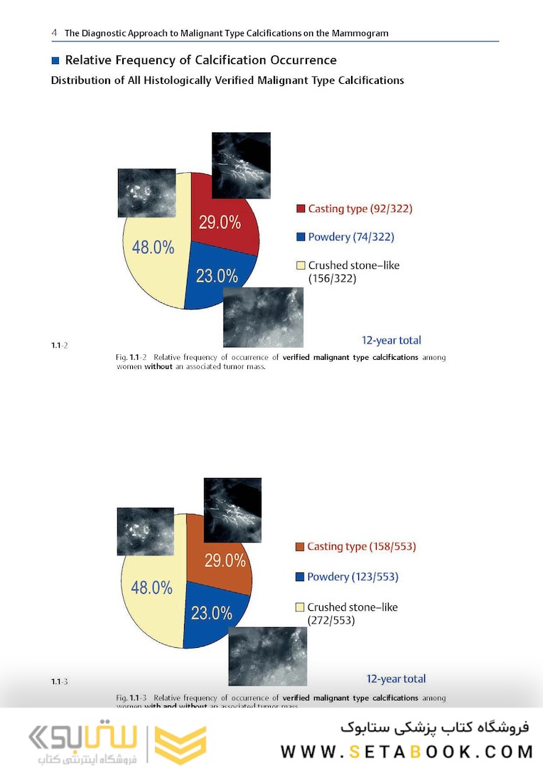 Breast Cancer: Early Detection with Mammography: Crushed Stone-like Calcifications: The Most Frequent Malignant Type 1st Edicion 2008