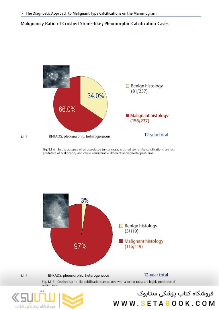 Breast Cancer: Early Detection with Mammography: Crushed Stone-like Calcifications: The Most Frequent Malignant Type 1st Edicion 2008