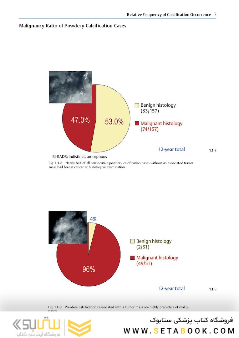 Breast Cancer: Early Detection with Mammography: Crushed Stone-like Calcifications: The Most Frequent Malignant Type 1st Edicion 2008