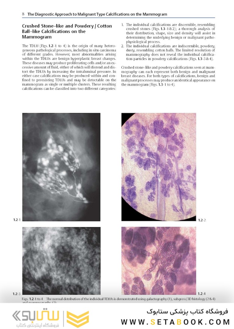 Breast Cancer: Early Detection with Mammography: Crushed Stone-like Calcifications: The Most Frequent Malignant Type 1st Edicion 2008