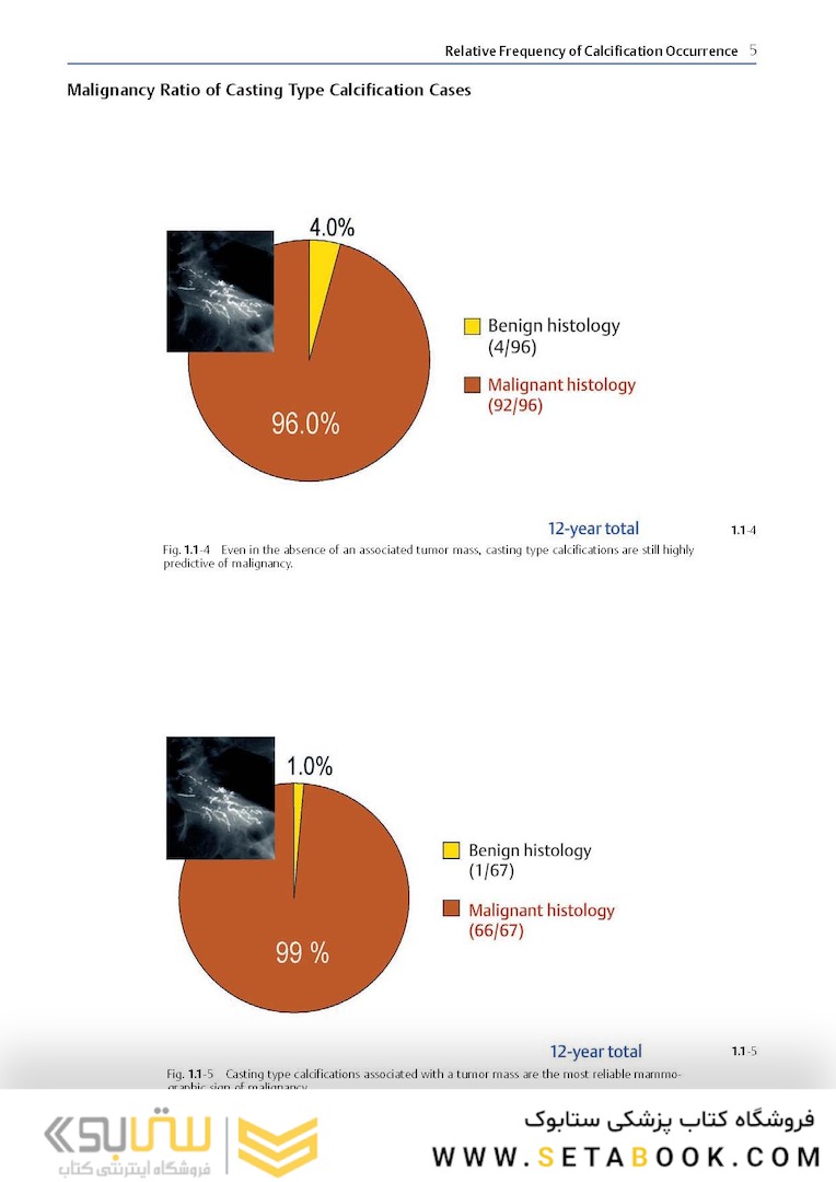 Breast Cancer: Early Detection with Mammography: Crushed Stone-like Calcifications: The Most Frequent Malignant Type 1st Edicion 2008