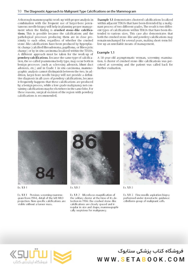 Breast Cancer: Early Detection with Mammography: Crushed Stone-like Calcifications: The Most Frequent Malignant Type 1st Edicion 2008