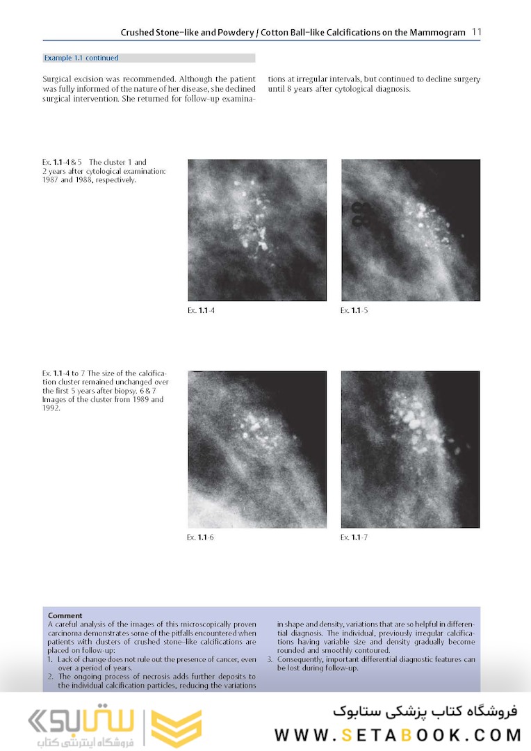 Breast Cancer: Early Detection with Mammography: Crushed Stone-like Calcifications: The Most Frequent Malignant Type 1st Edicion 2008