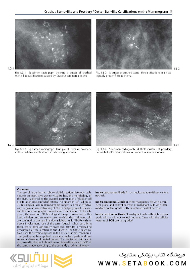 Breast Cancer: Early Detection with Mammography: Crushed Stone-like Calcifications: The Most Frequent Malignant Type 1st Edicion 2008