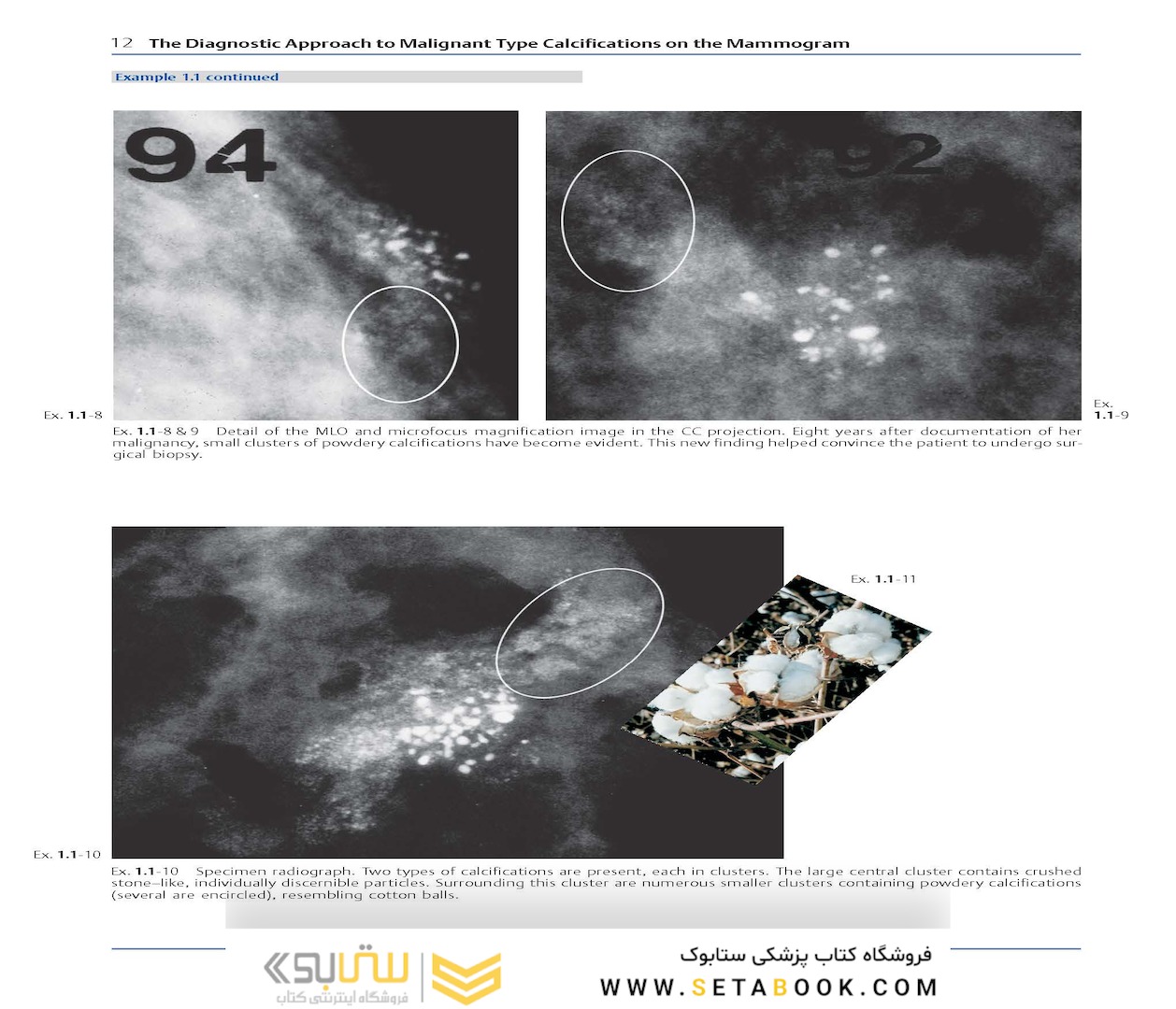 Breast Cancer: Early Detection with Mammography: Crushed Stone-like Calcifications: The Most Frequent Malignant Type 1st Edicion 2008