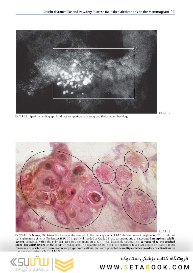 Breast Cancer: Early Detection with Mammography: Crushed Stone-like Calcifications: The Most Frequent Malignant Type 1st Edicion 2008