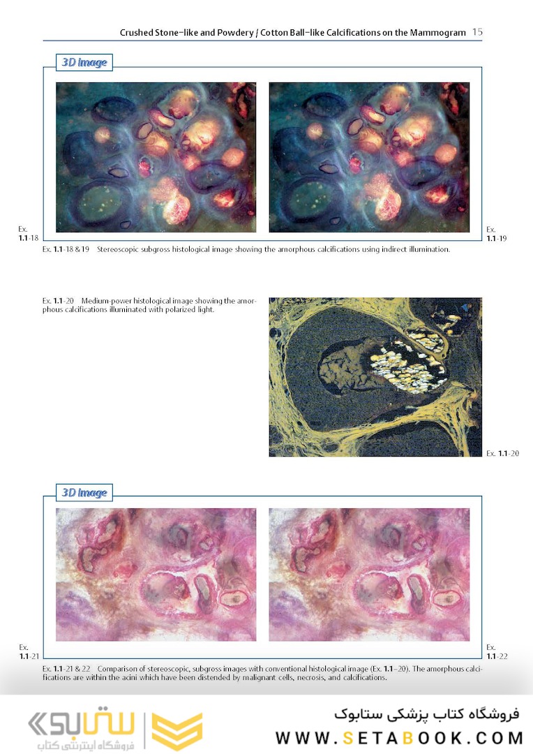Breast Cancer: Early Detection with Mammography: Crushed Stone-like Calcifications: The Most Frequent Malignant Type 1st Edicion 2008